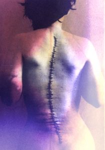 The Attentive Body/Elaine Konopka blog scars